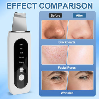 Peeling Ultrasónico Facial, 5 En 1 Espatula Para Limpieza Facial, Eliminador De Puntos Negros, Limpieza De Poros, Raspador Ultrasónico Facial, Limpiador De Poros Portátil